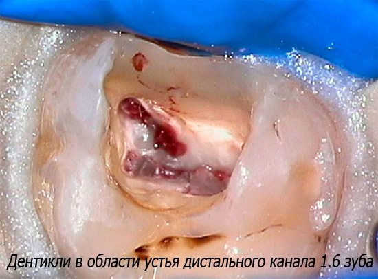 Dentikli an der Mündung des distalen Zahnkanals