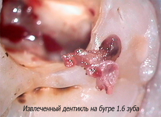 E questa fotografia mostra un denticolo estratto da un dente.