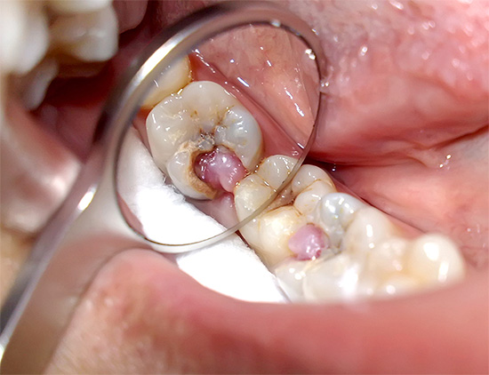 The photo shows an example of hypertrophic pulpitis, when the pulp fills almost the entire carious cavity.