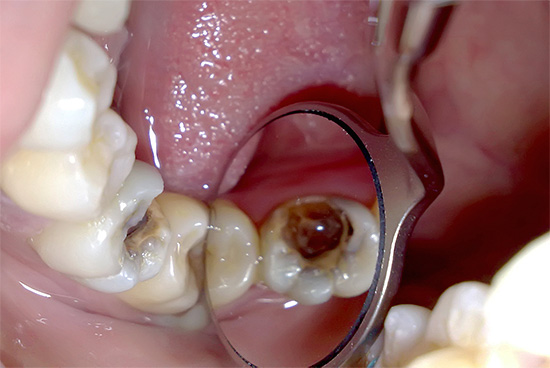Een van de moeilijkste voor een praktiserende tandarts is de classificatie van pulpitis volgens ICD-10.