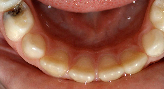 En la majoria dels casos, la pulpitis es produeix per infecció de la polpa per bacteris que penetren a l’interior de la dent a través de la cavitat cariària.
