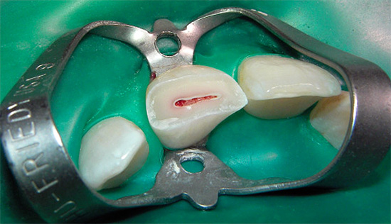 De foto toont een gebroken tand, waarin de pulpakamer duidelijk zichtbaar is ...