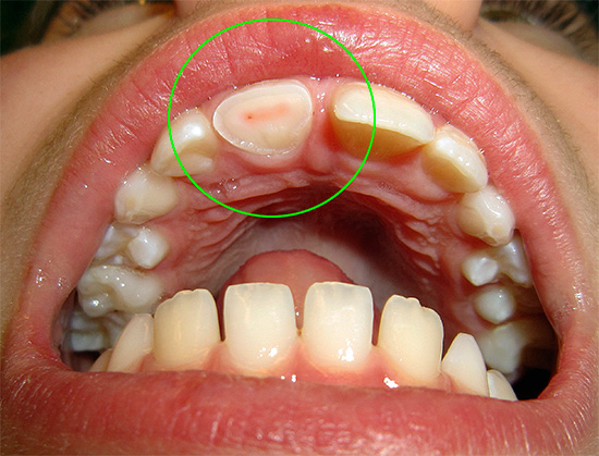La pulpite traumatica è causata da una violazione della sterilità della camera pulpare, quando, a causa della sua apertura, i batteri della cavità orale vi entrano in grandi quantità.