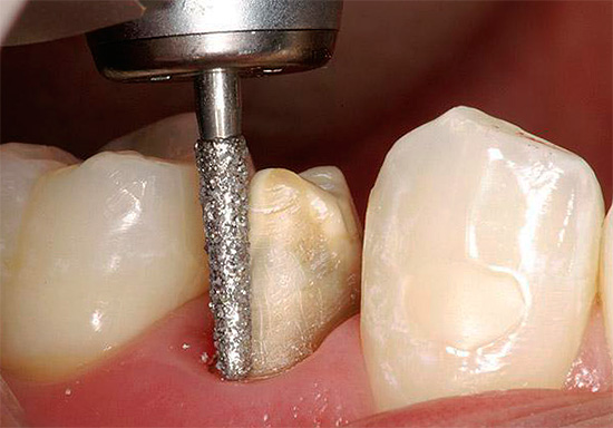 Pri brúsení zubu pod korunou sa buničina môže prehriať, čo si v budúcnosti bude vyžadovať aj ošetrenie ...