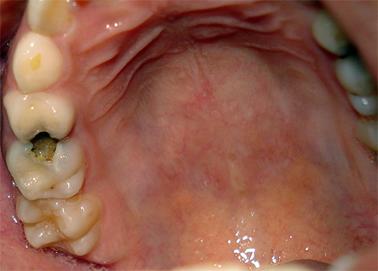 У случају акутне зубобоље (на пример, са пулпитисом), узимање Но-Схпа биће бескорисно.