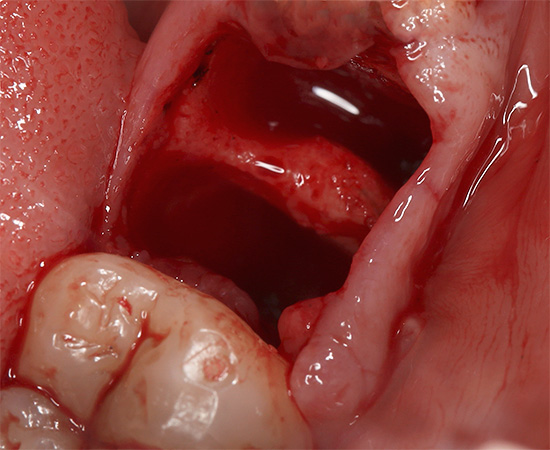 Die Folge des Entfernens eines Zahns kann eine anhaltende Blutung aus dem Loch sein ...