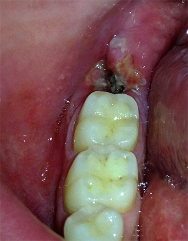 Ein Temperaturanstieg kann auch auf eine schwere Entzündung der Zahnpfanne hinweisen.
