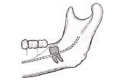 Pašalinus išminties dantis, kartais pažeidžiamas apatinio žandikaulio nervas, apatinio žandikaulio nervas, dėl kurio atsiranda parestezija.