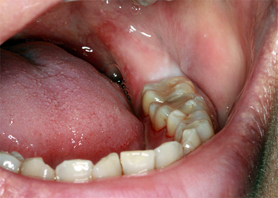 Gigi kebijaksanaan retarded tidak kelihatan, kerana ia benar-benar tersembunyi di bawah gusi.