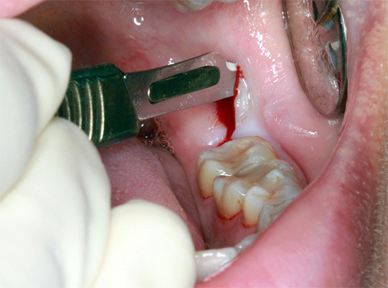 Zahnfleischabschnitt