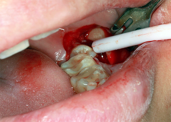 Lorsque les bords de la gencive coupée sont écartés, la dent de sagesse précédemment cachée devient visible.