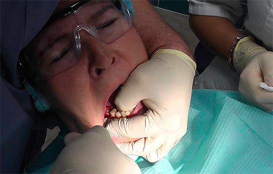 Étant donné que le médecin exerce une force considérable lors du retrait de la dent, le glissement de l'outil entraîne parfois de graves blessures des tissus mous environnants.