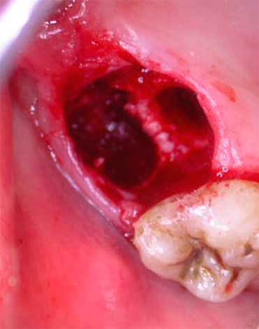 Un problema força greu que de vegades sorgeix després de l'extracció de dents és també l'alveolitis, inflamació de les parets del forat.