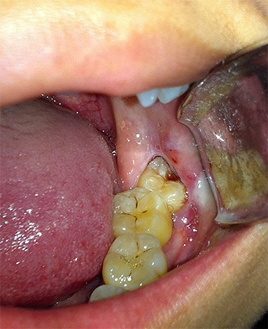 Fotografie ukazuje spodní zub moudrosti zasažený hlubokým kazem, jehož část je skrytá pod dásní.