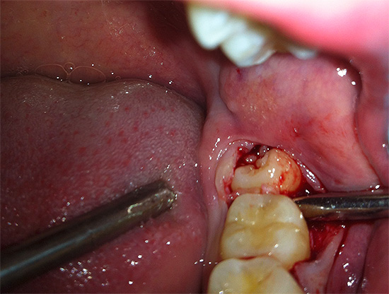 U većini slučajeva osmi donji zub je mnogo teže ukloniti nego osmi na gornjoj čeljusti.