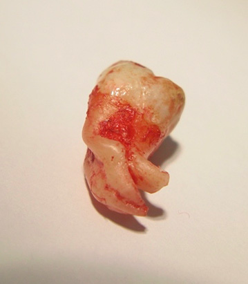 The roots of wisdom teeth can be quite bizarre ...