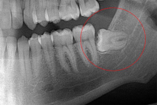 Rentgeno nuotrauka aiškiai parodo, kaip tiksliai išminties dantis yra žandikaulyje - tai palengvina gydytojo darbą ir sumažina galimų klaidų riziką.
