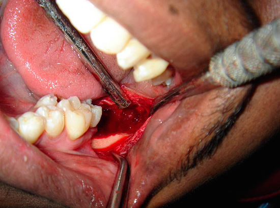 Dalam gambar ini jelas kelihatan bahawa di tempat gigi kebijaksanaan yang dihapuskan, luka agak ketara masih di kawasan.