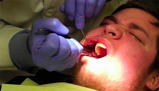 Među neugodne posljedice uklanjanja mudrog zuba su razne medicinske pogreške, uključujući prijelom donje čeljusti ili puknuće uglova pacijentova usta.