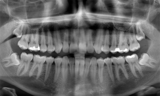 Un creixement inadequat de les dents de saviesa pot alterar significativament la picada.