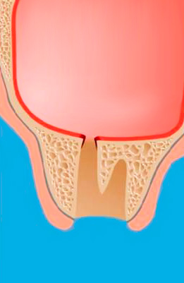 Perforation du sinus maxillaire lors du retrait de la dent supérieure.
