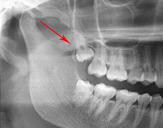De vegades, les dents de saviesa, tant superior com inferior, es poden amagar parcialment o completament sota la geniva.