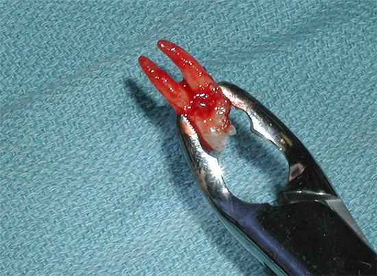 With proper ingenuity and dexterity, dental surgeons manage to use bayonet-shaped forceps to remove both upper and lower teeth.
