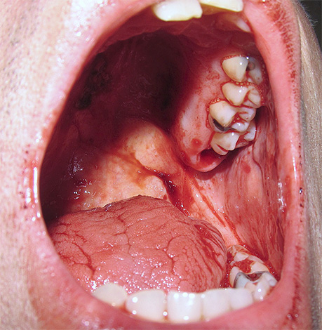 Na fotografii je jasne viditeľný krvácajúci otvor na mieste zubu múdrosti odstránený z hornej čeľuste.