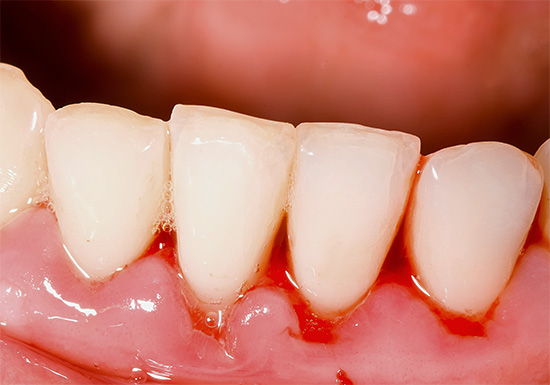 Bosbalsempasta's helpen echt bij tandvleesaandoeningen - met bloeding, ontsteking en hoge gevoeligheid.