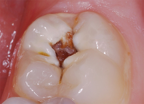 Insertion of garlic into the cavity will only intensify the toothache ...