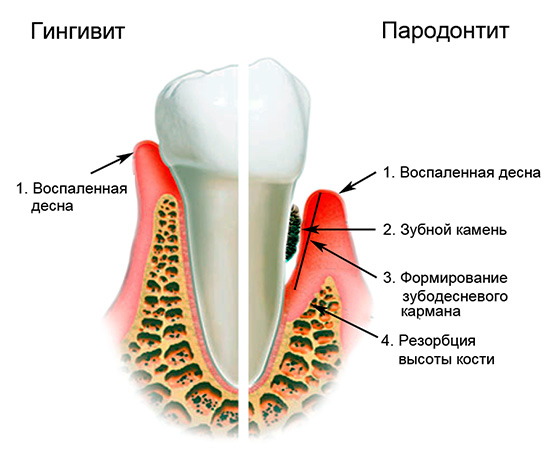 Attēlā parādīta to procesu būtība, kas notiek ar smaganām un kaulu audiem ar gingivītu un periodontītu.