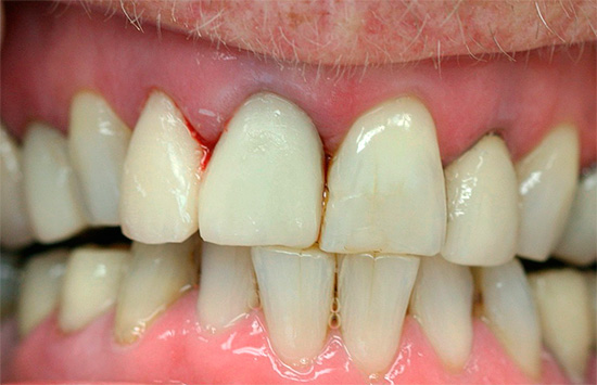 Vitlök kan verkligen antiseptisera platsen för inflammation, men med långvarig kontakt med tandköttet kommer det att bränna.