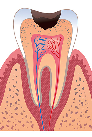 หากคุณใส่กระเทียมในช่องที่มีฟันผุลึกเป็นเวลานานสิ่งนี้อาจนำไปสู่การตายของเยื่อกระดาษ