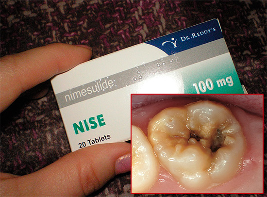 Lassen Sie uns über die Verwendung von Nise-Tabletten zur Linderung von Zahnschmerzen sprechen - hilft dieses Medikament wirklich und auch, was vor der Anwendung zu wissen ist ...