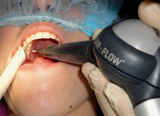 Podczas wybielania zębów za pomocą technologii Air-Flow nie zawsze jest możliwe całkowite usunięcie kamienia nazębnego.