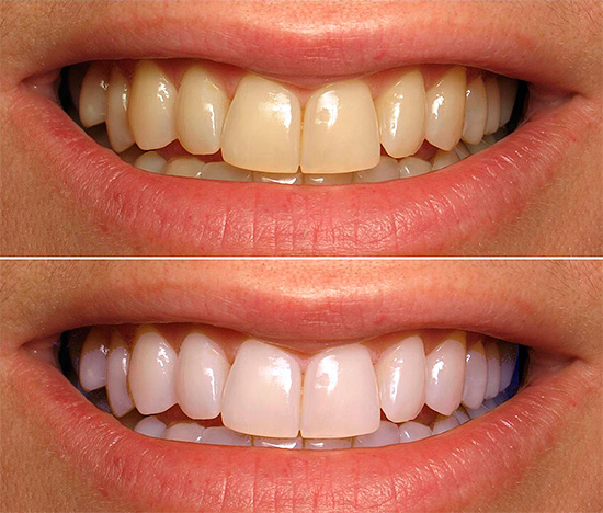 Le blanchiment des dents est le moyen le plus efficace (la photo montre l'état de la zone du sourire avant et après l'intervention).