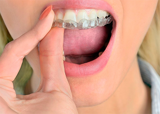 The use of cap allows you to prevent the effects of bleaching gel on the gums.
