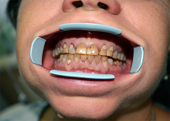 The presence of a large number of fillings and carious foci is a contraindication to teeth whitening in a chemical way.