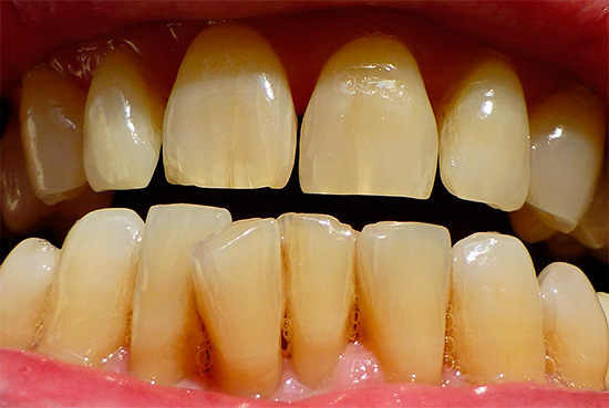 Bevor Sie mit dem Aufhellen Ihrer Zähne beginnen, sollten Sie herausfinden, welche Methode in Ihrer Situation vorzuziehen ist.