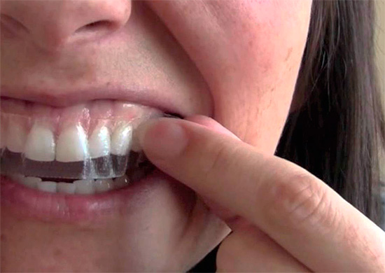 การใช้แถบฟอกสีฟันอย่างไม่เหมาะสมอาจทำให้เหงือกไหม้อย่างรุนแรง