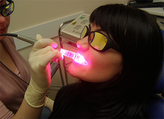 Lasersko izbjeljivanje zuba je svojstveno kemijskom, a laser se koristi samo kao aktivator peroksidnih spojeva.