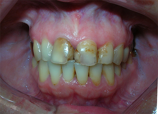 La presencia de empastes viejos en el método químico de blanqueamiento dental puede conducir a la filtración del gel en microgrietas, lo que a veces causa dolor intenso.