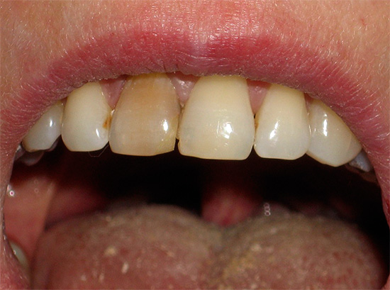 Le blanchiment intracanal vous permet d'éclaircir les dents mortes foncées.