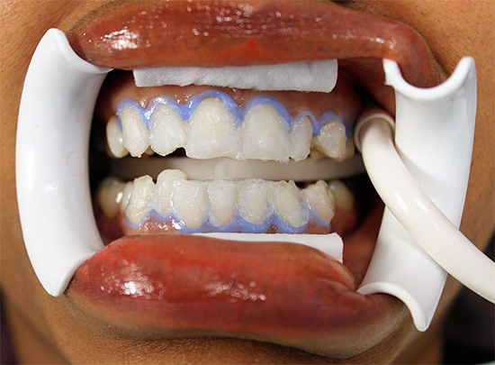 A la foto es mostra un exemple de blanquejament de dents químiques a la consulta del dentista.