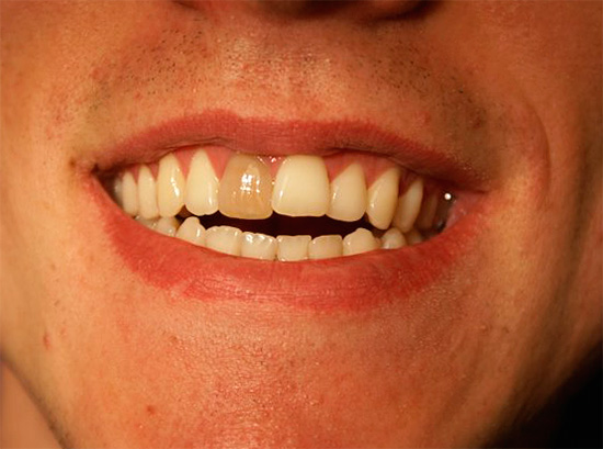 Fotografie potemnělého mrtvého zubu před postupem bělení.