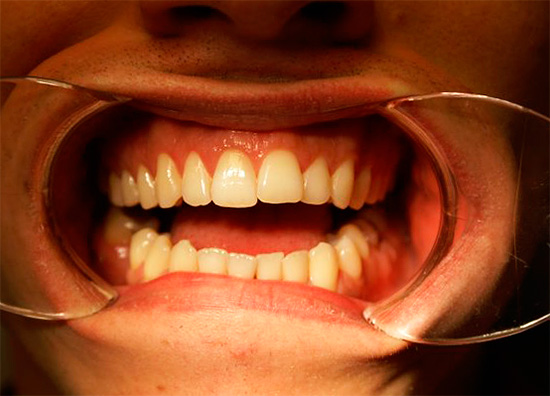 En dezelfde tand ziet eruit na het bleken van endotheel.
