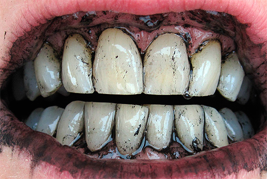 Izbjeljivanje zuba s aktivnim ugljikom rijetko je učinkovito.