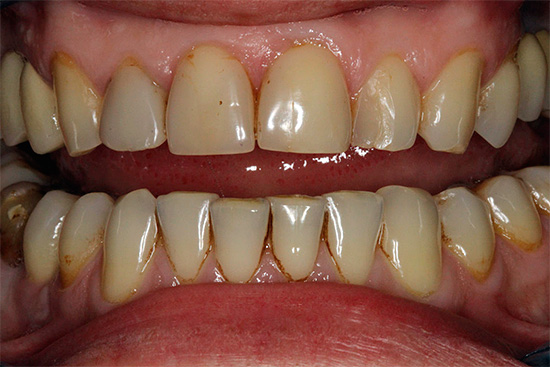 Met een overvloed aan tandsteen en tandplak is het raadzaam om professionele mondhygiëne uit te voeren - dit zal de lachzone onmiddellijk witter maken.