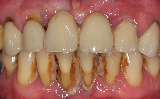 La foto mostra un exemple de tàrtar abundant a les dents inferiors frontals.