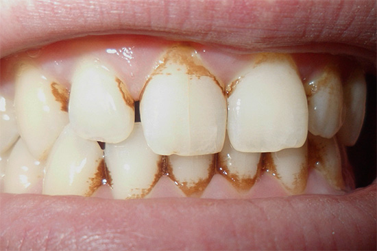 Takéto bieliace zubné pasty z Thajska sa dajú veľmi rýchlo odstrániť.
